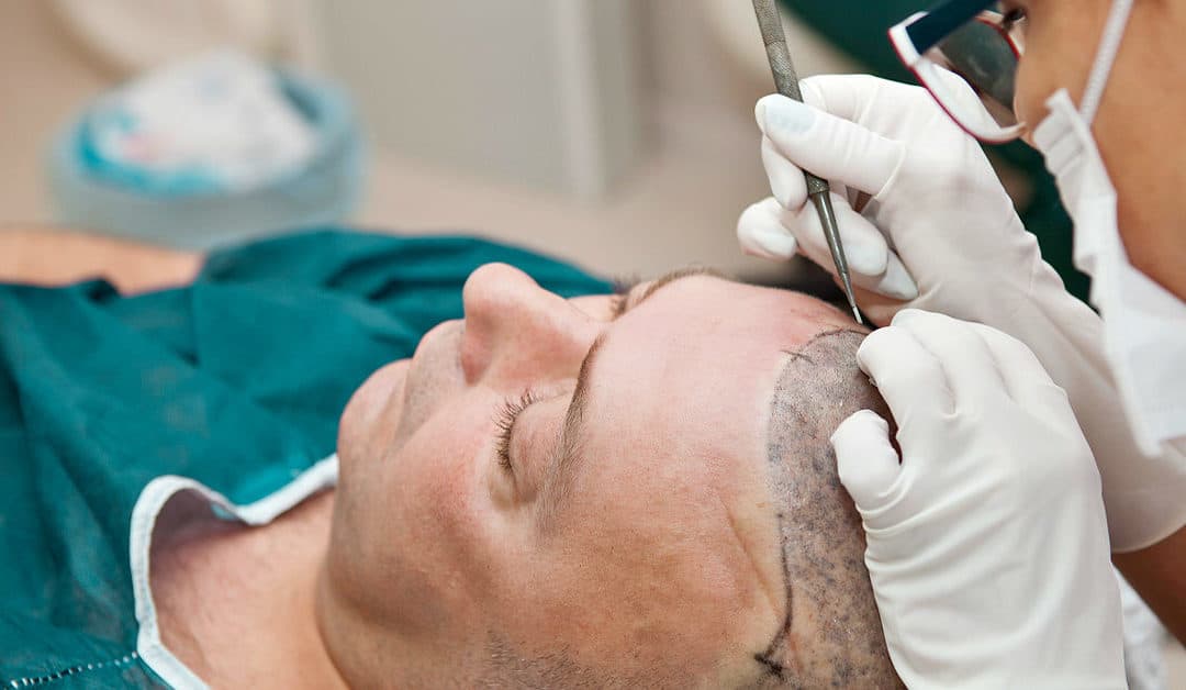 Should You Consider Hair Transplant Surgery for Hair Loss?