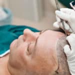 Should You Consider Hair Transplant Surgery for Hair Loss?