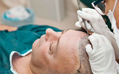 Should You Consider Hair Transplant Surgery for Hair Loss?