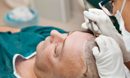 Should You Consider Hair Transplant Surgery for Hair Loss?