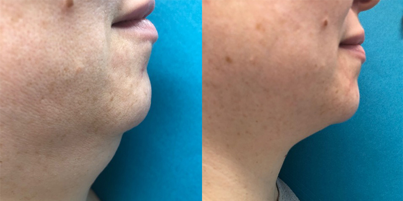 Kybella Before and After Gallery by Dr. Burnett in Wellesley Massachusetts