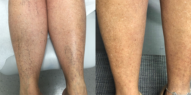 Leg Veins Before and After Gallery by Dr. Burnett in Wellesley Massachusetts