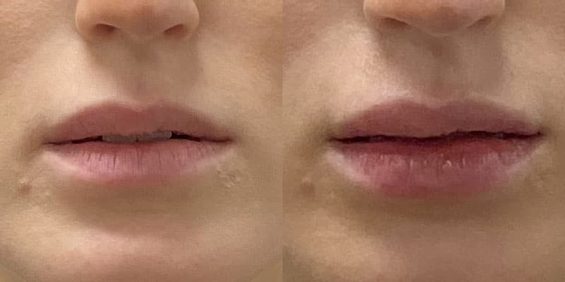 Lip Filler Before and After Gallery by Dr. Burnett in Wellesley Massachusetts