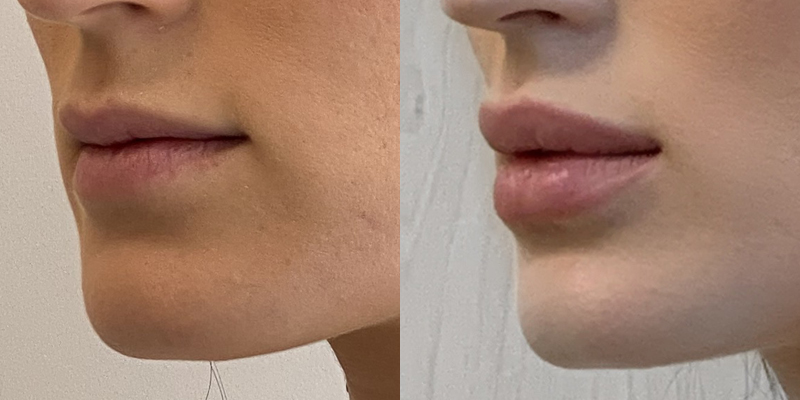 Lip Filler Before and After Gallery by Dr. Burnett in Wellesley Massachusetts