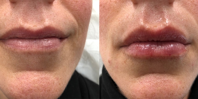 Lip Filler Before and After Gallery by Dr. Burnett in Wellesley Massachusetts