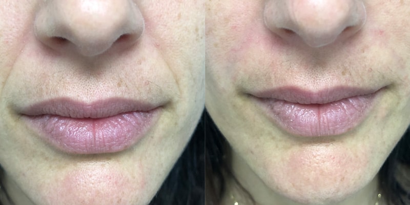 NLF Filler Before and After Gallery by Dr. Burnett in Wellesley Massachusetts