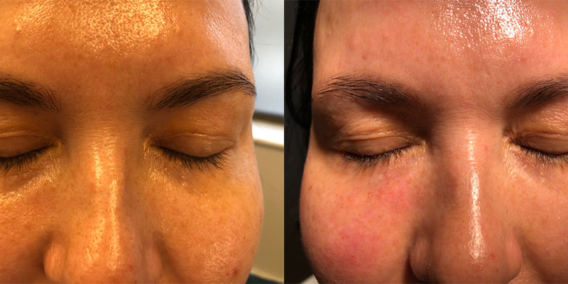 Tear Through Filler Before and After Gallery by Dr. Burnett in Wellesley Massachusetts