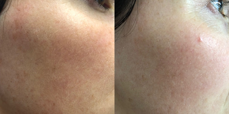 Laser Before and After Gallery by Dr. Burnett in Wellesley Massachusetts