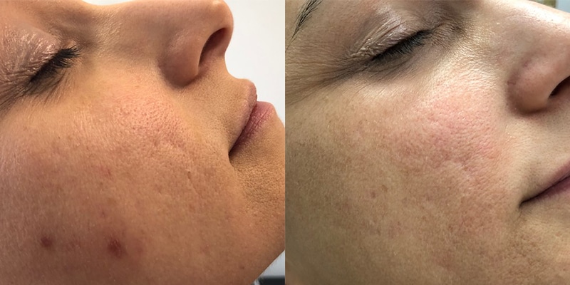 Laser Before and After Gallery by Dr. Burnett in Wellesley Massachusetts