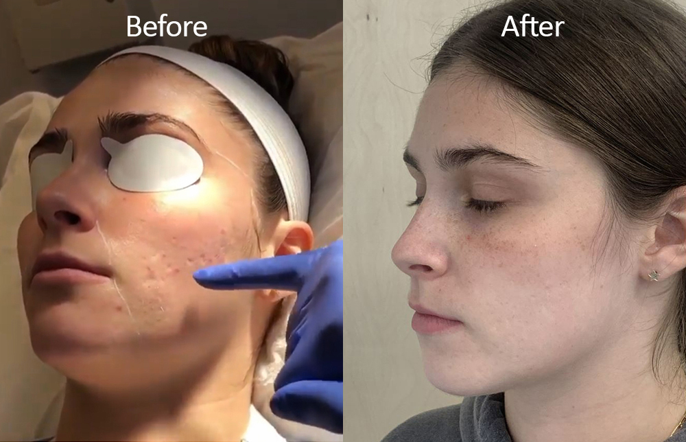 Acne Scarring Before and After Gallery by Dr. Burnett in Wellesley Massachusetts