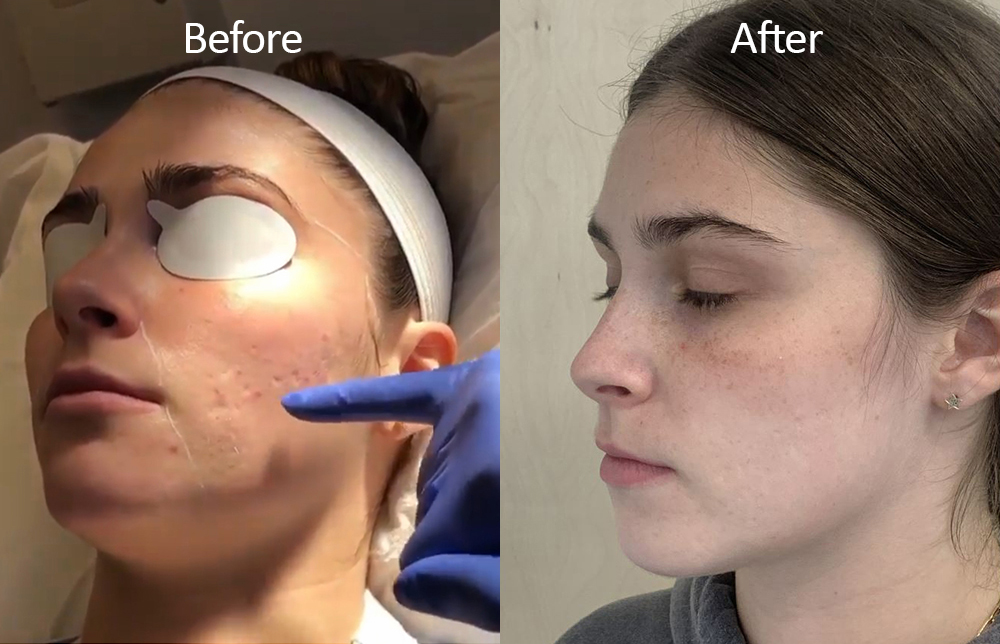 Acne Scarring Before and After Gallery by Dr. Burnett in Wellesley Massachusetts