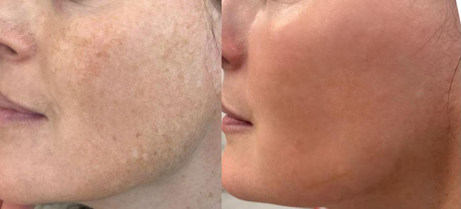 IPL Before and After Gallery by Dr. Burnett in Wellesley Massachusetts