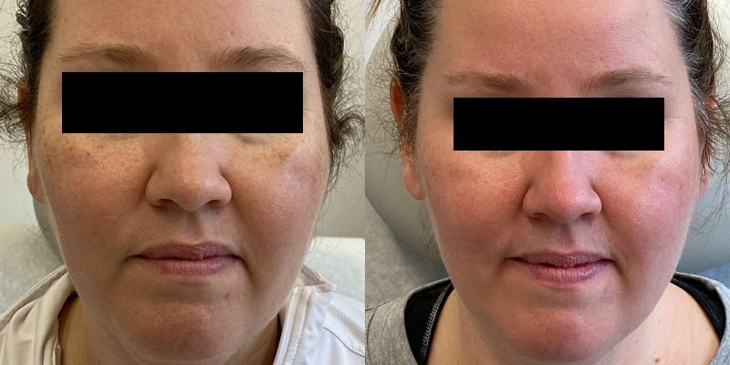 IPL Before and After Gallery by Dr. Burnett in Wellesley Massachusetts