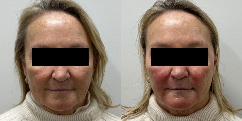 Liquid Facelift Before and After Gallery by Dr. Burnett in Wellesley Massachusetts