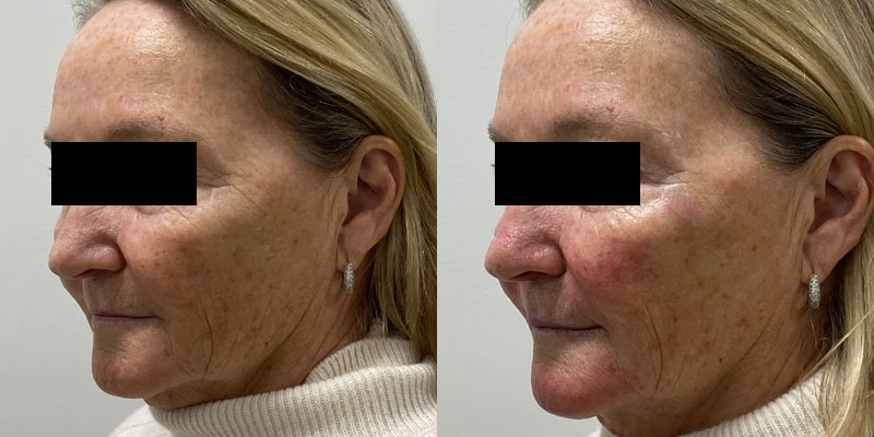 Liquid Facelift Before and After Gallery by Dr. Burnett in Wellesley Massachusetts