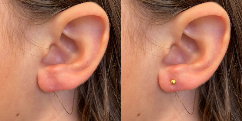 Ear Piercing Before and After Gallery by Dr. Burnett in Wellesley Massachusetts