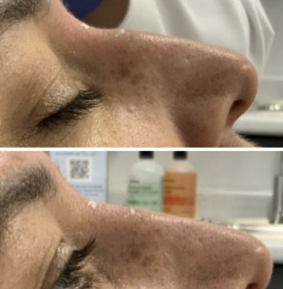 Before and After photo - Nose - Premier Dermatology