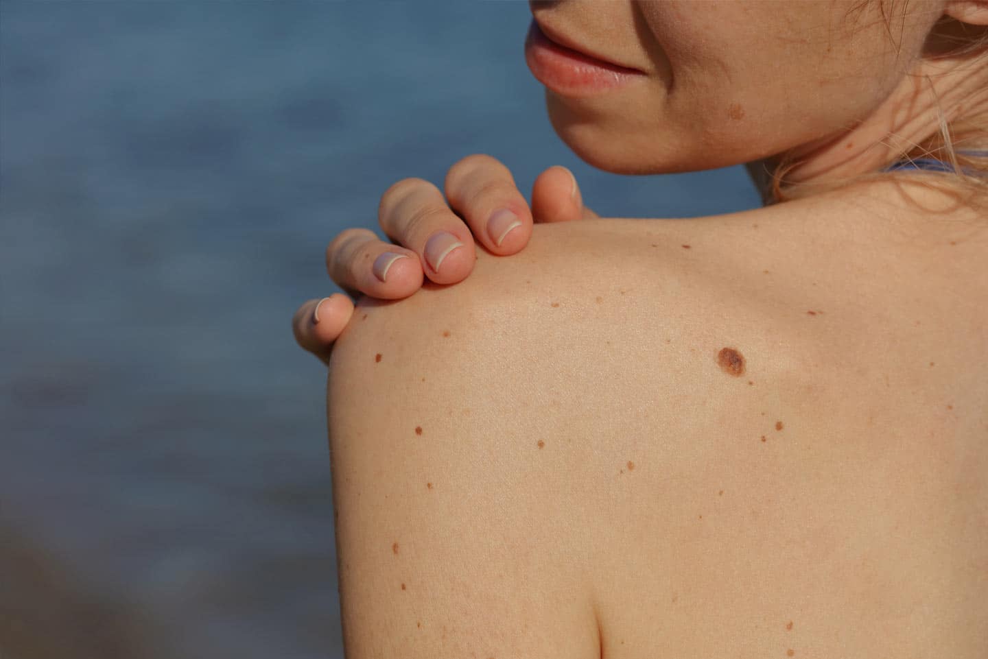 Elective-Mole-Removal-treatment2 Elective-Mole-Removal wellesley premier dermatology