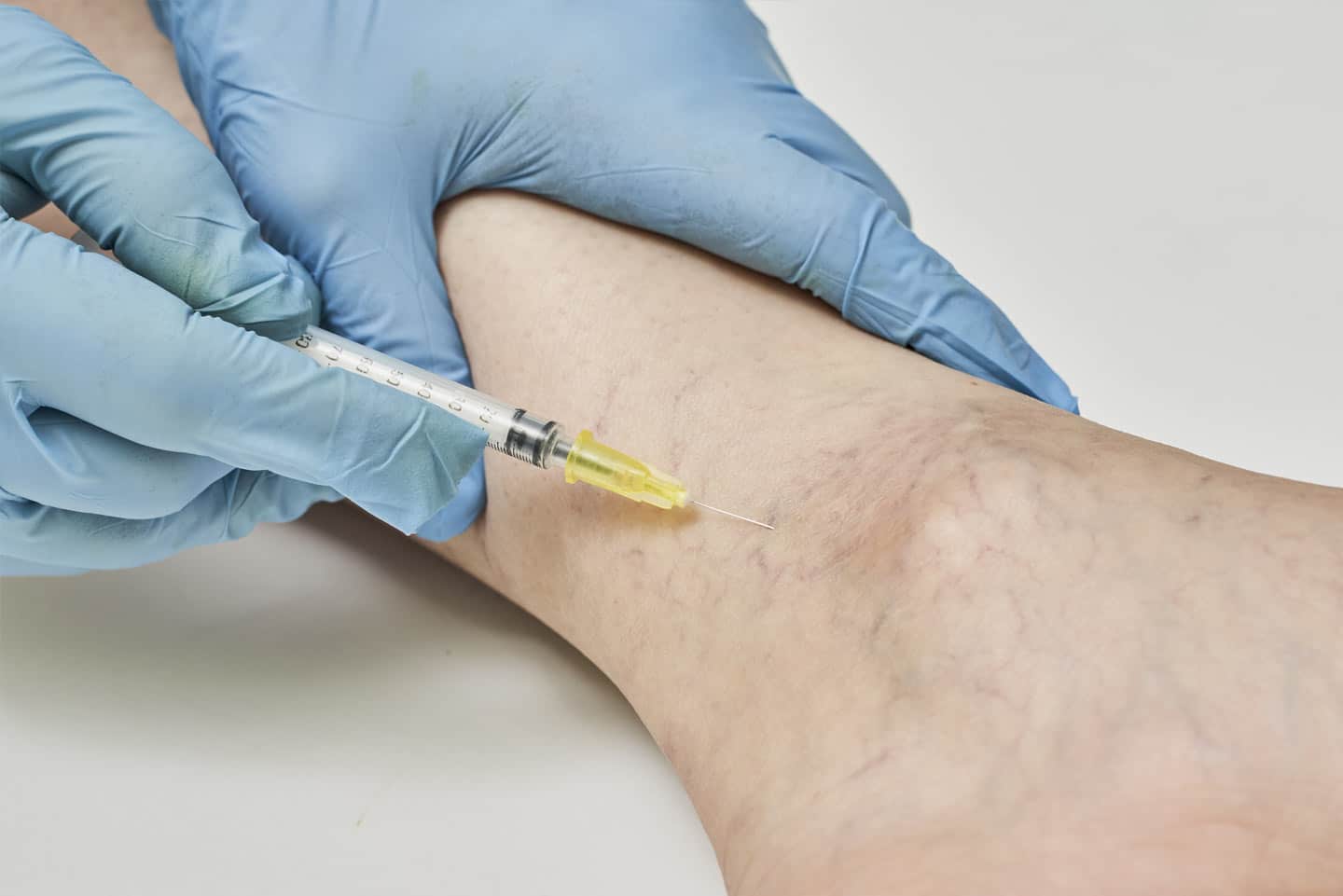 Sclerotherapy wellesley premier dermatology