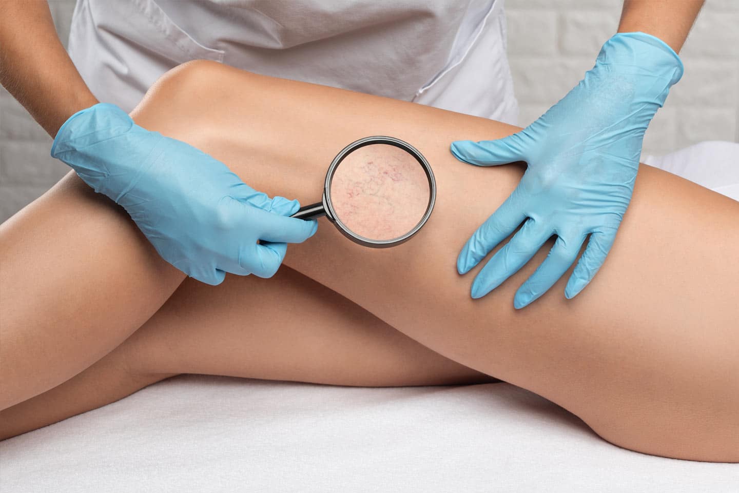 Sclerotherapy wellesley premier dermatology