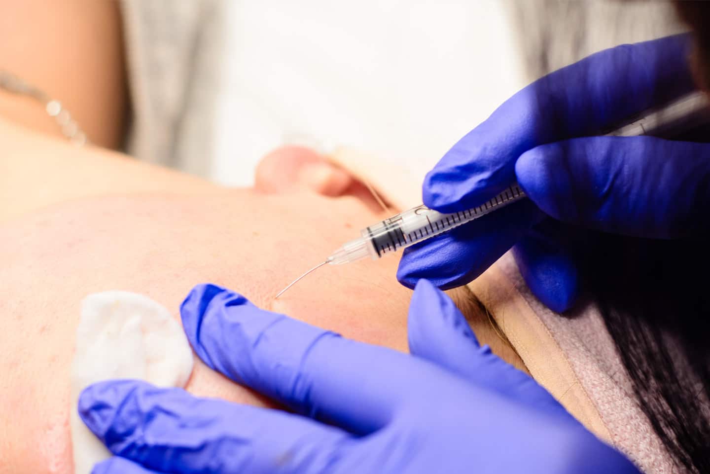Subcision-for-Acne-Scars-treatment Subcision-for-Acne-Scars wellesley premier dermatology