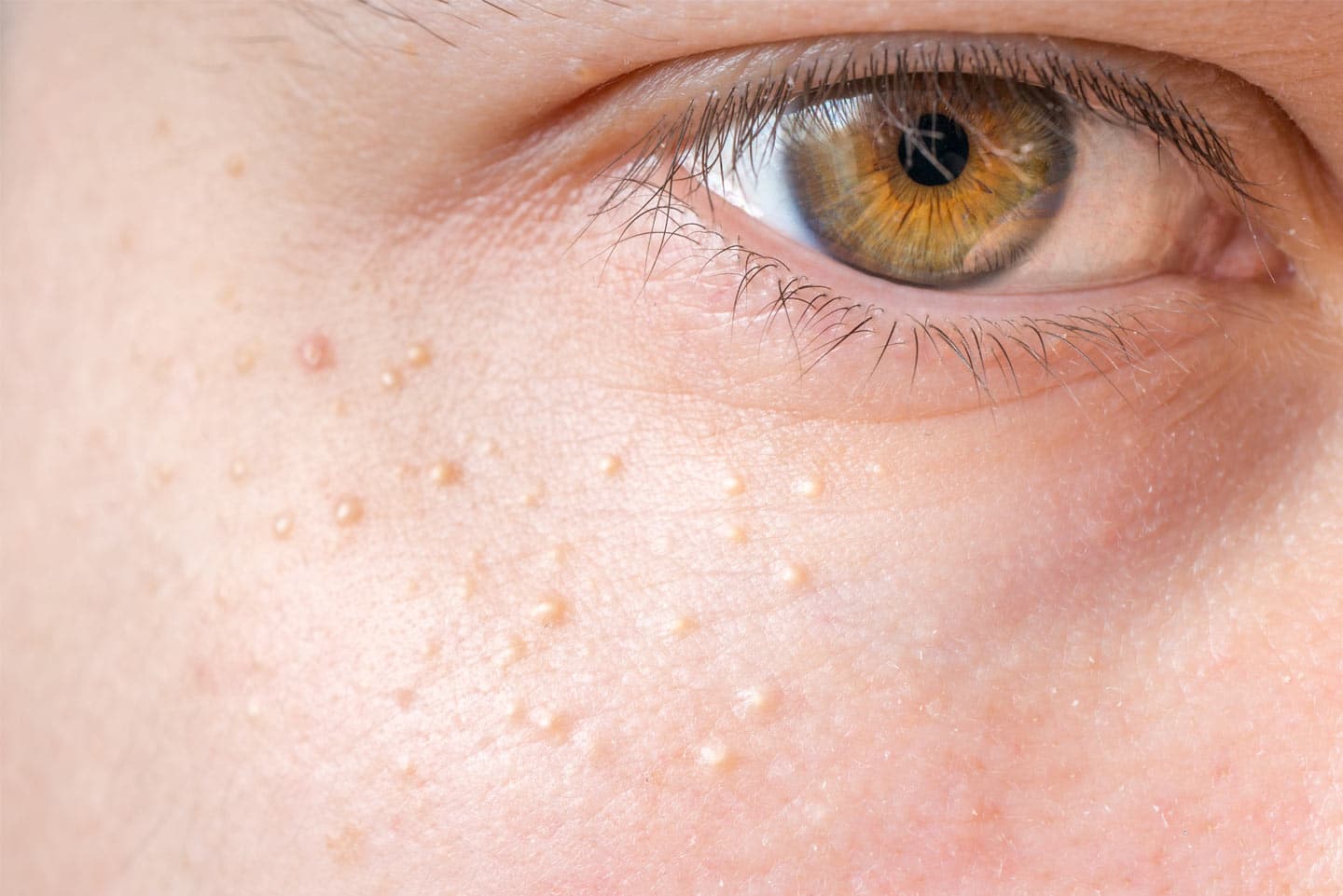 Treatment-of-Milia,-Skin-Tags-and-Other-Skin-Growths-image-2 wellesley premier dermatology