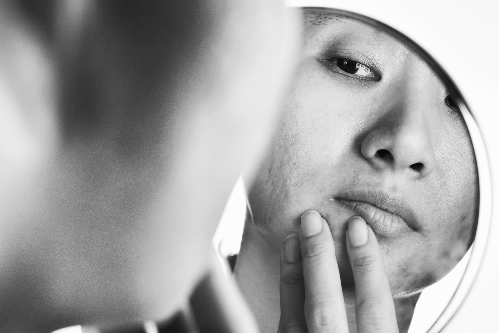 acne-image-treatment acne treatment wellesley premier dermatology