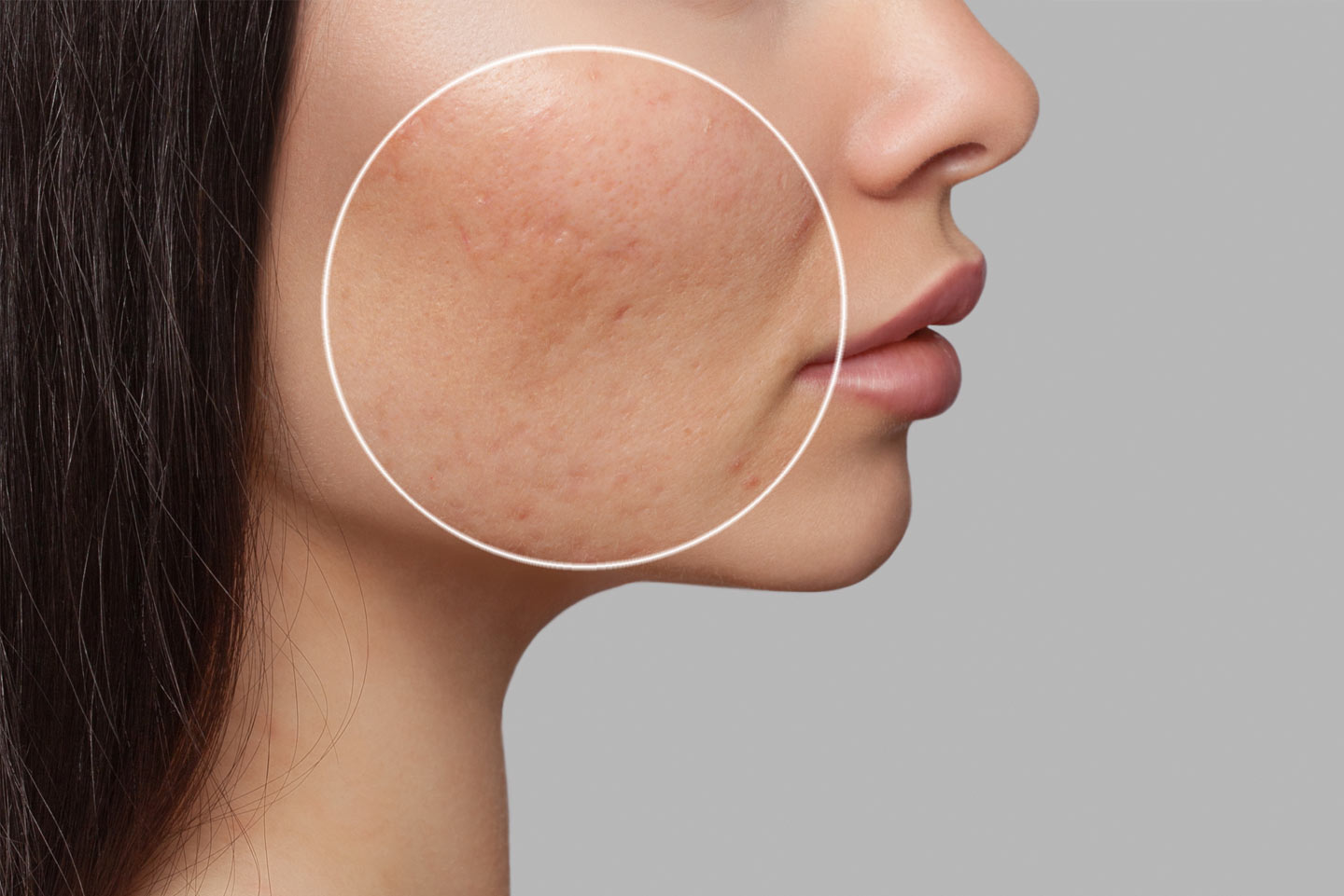 acne-scar-treatment wellesley premier dermatology