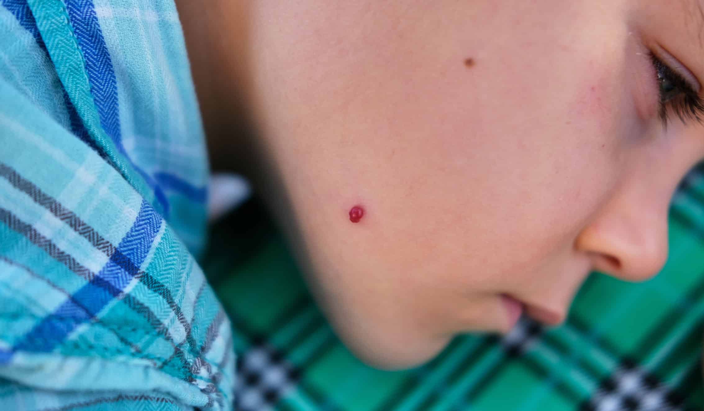 birth mark wellesley premier dermatology child with birthmark on chin