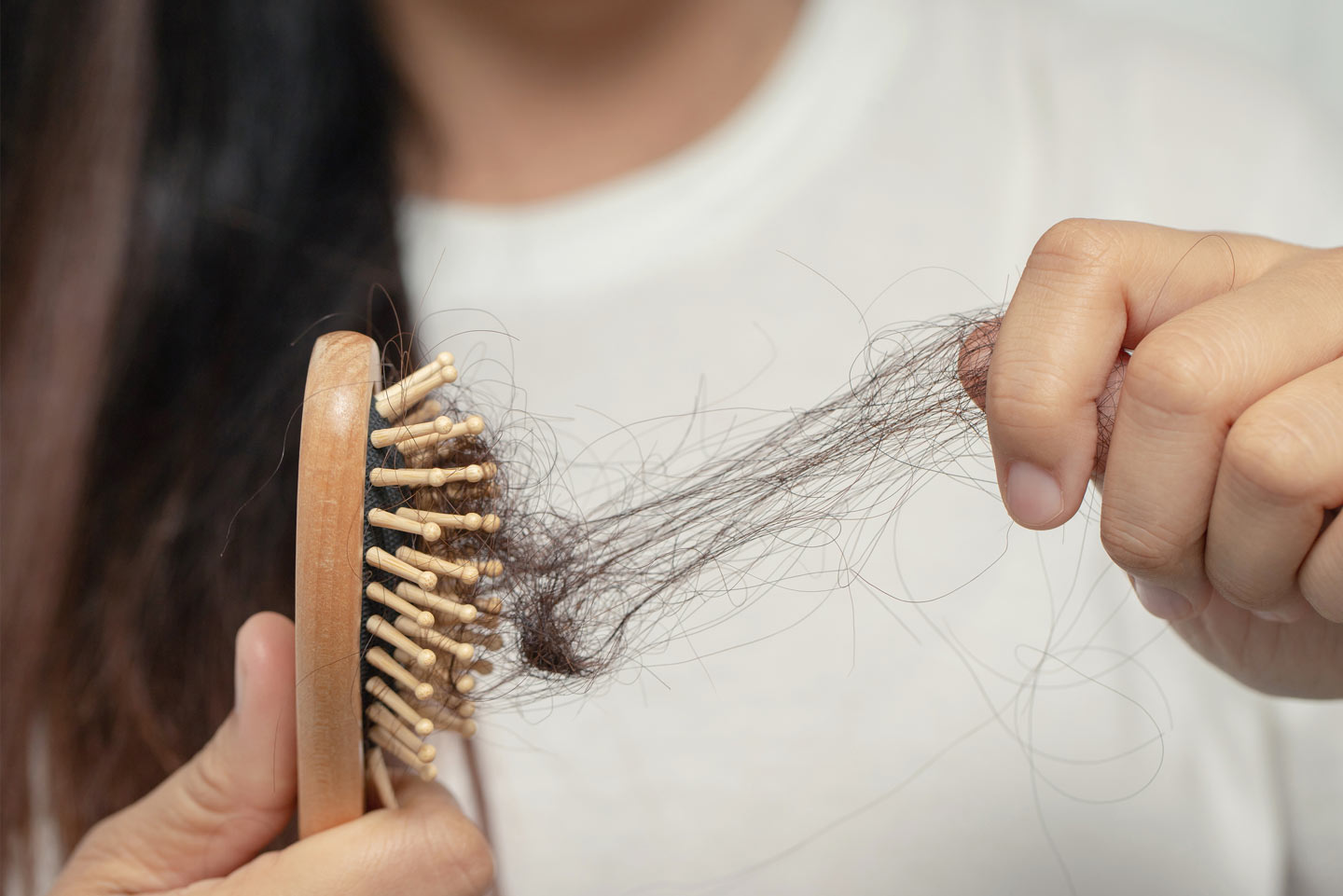 Woman hair loss from shampoo allergy Wellesley Premier Dermatology
