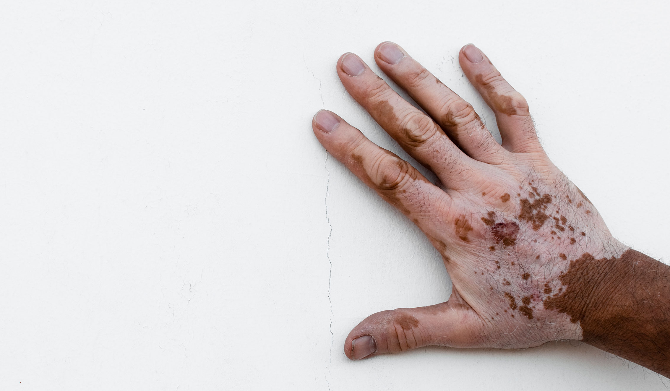 hand with vitiligo
