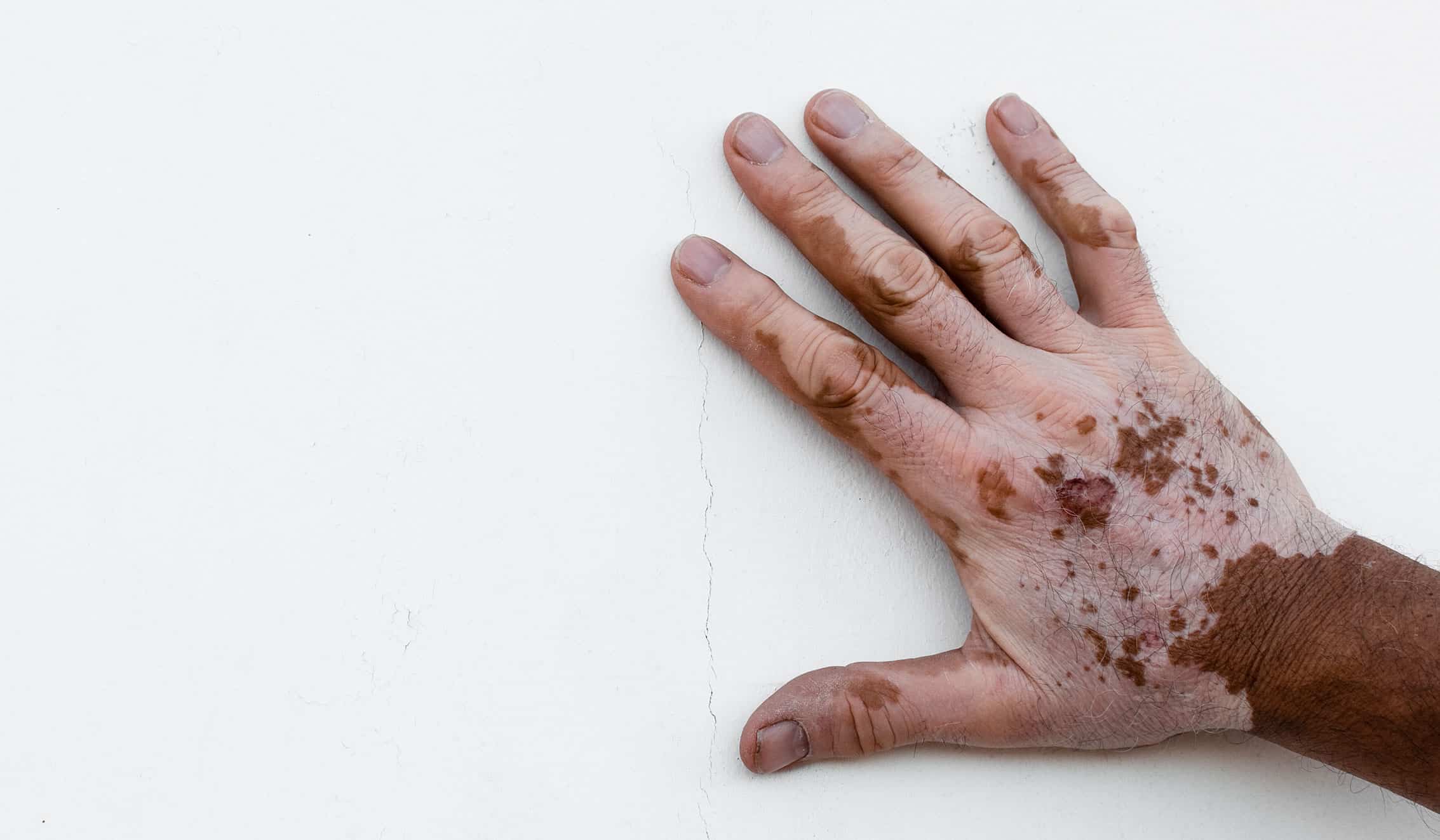 vitiligo wellesley premier dermatology hand with vitiligo