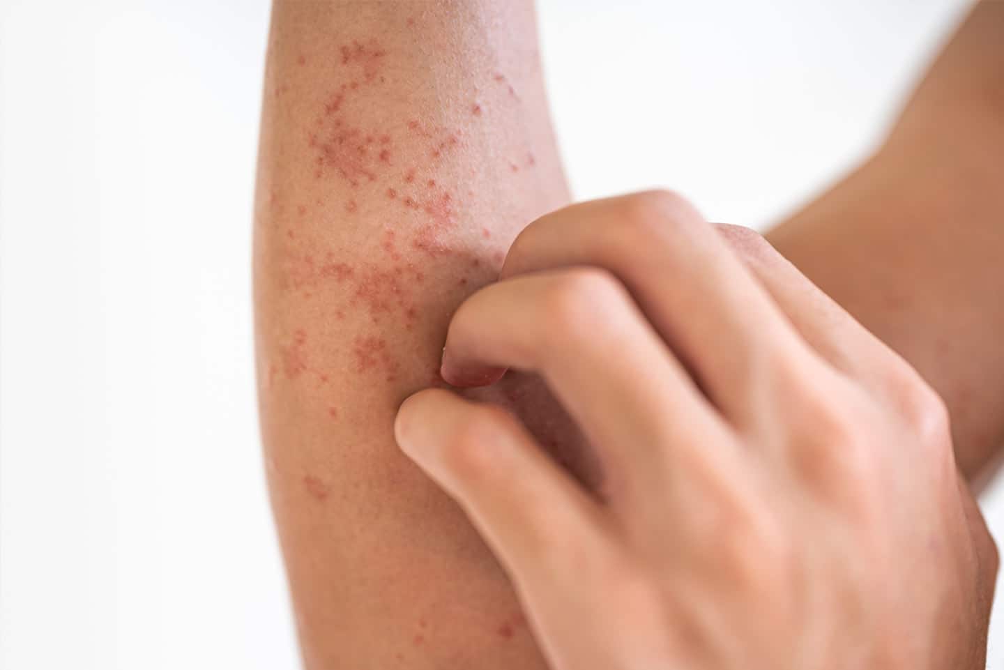 skin-infections-treatments-2 Infections (Fungal, Bacterial, Viral) 2 wellesley premier dermatology