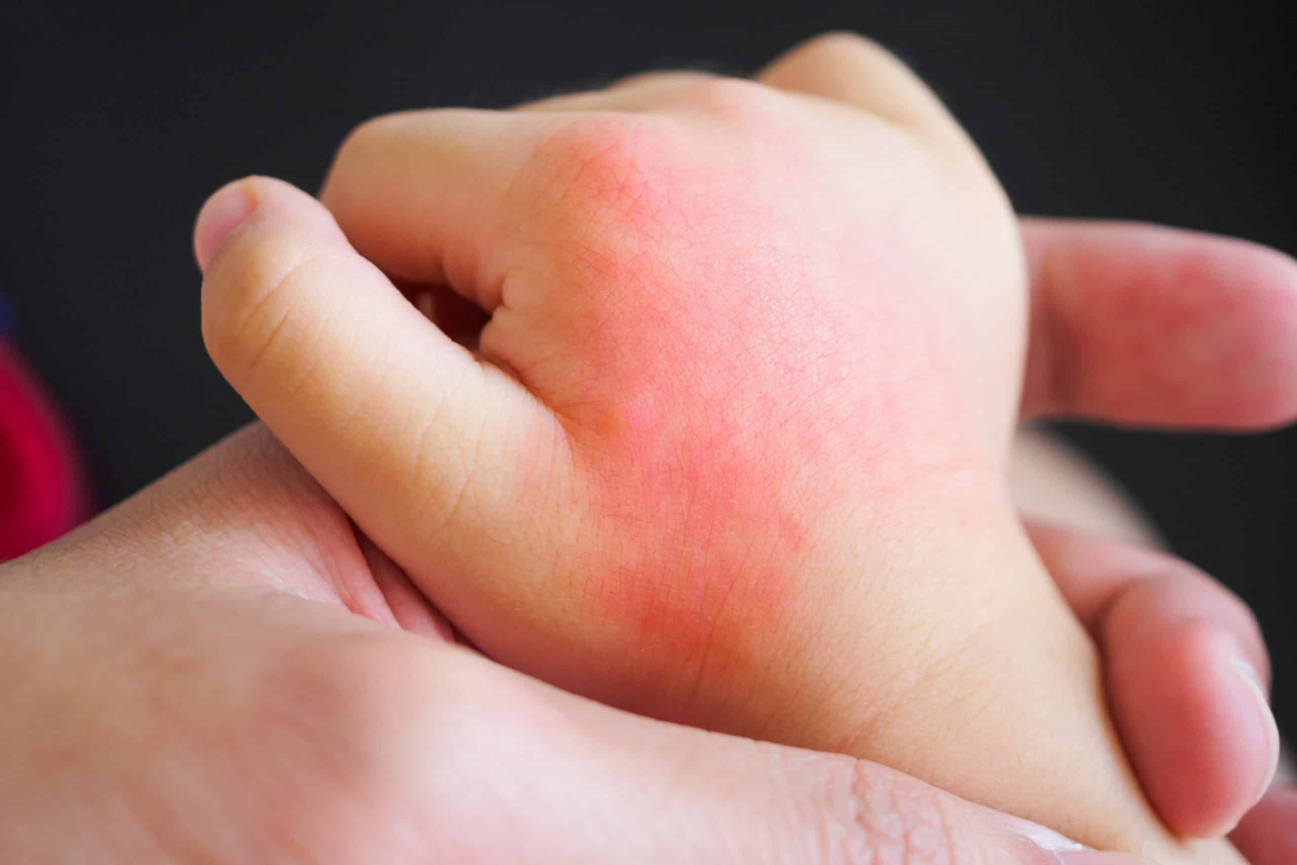 skin rash wellesley premier dermatology skin rash wellesley premier dermatology