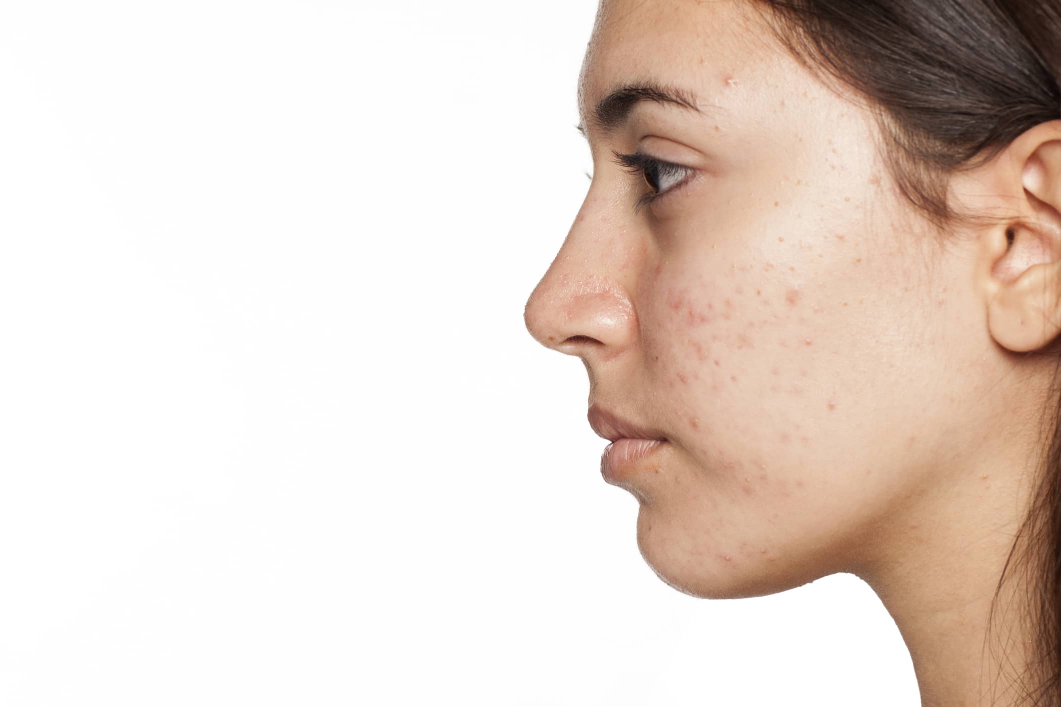 acne wellesley premier dermatology