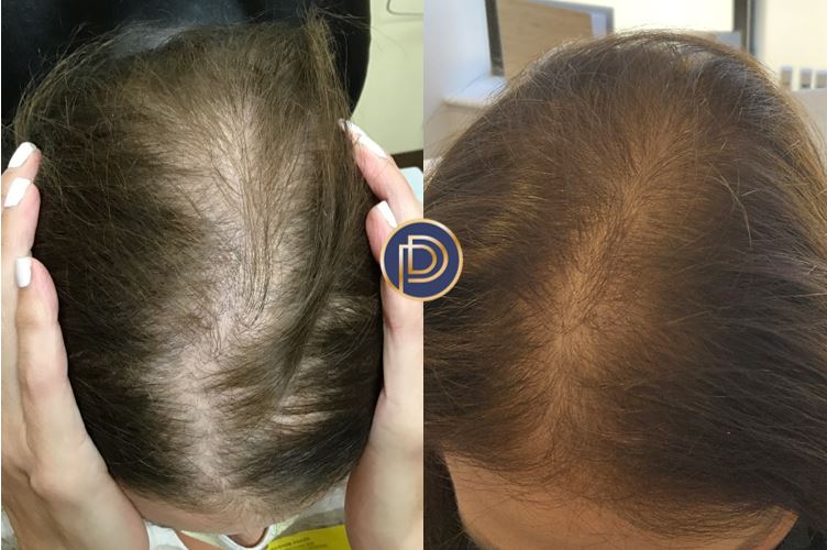 Hair Loss Before and After Gallery by Dr. Burnett in Wellesley Massachusetts
