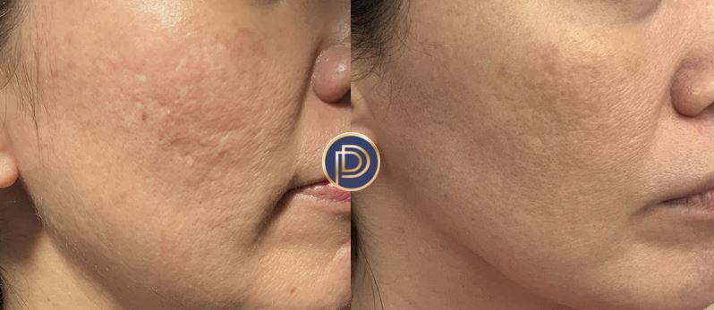 Radiofrequency Skin Tightening Treatment Morpheus 8 Results Wellesley