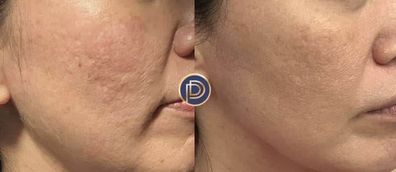 Radiofrequency Skin Tightening Treatment Morpheus 8 Results Wellesley