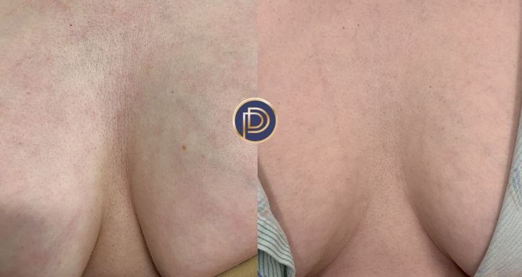 Morpheus Before and After Gallery by Dr. Burnett in Wellesley Massachusetts