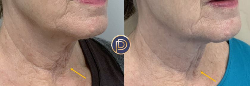 Morpheus Before and After Gallery by Dr. Burnett in Wellesley Massachusetts