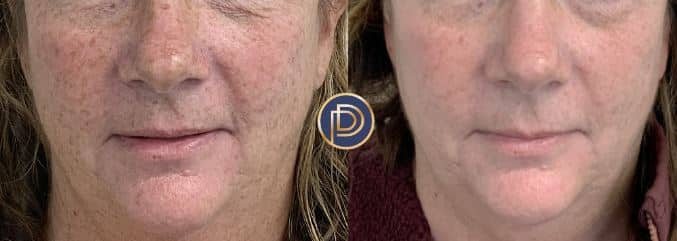 IPL Before and After Gallery by Dr. Burnett in Wellesley Massachusetts