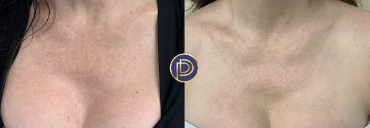 IPL Before and After Gallery by Dr. Burnett in Wellesley Massachusetts