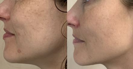 IPL Before and After Gallery by Dr. Burnett in Wellesley Massachusetts