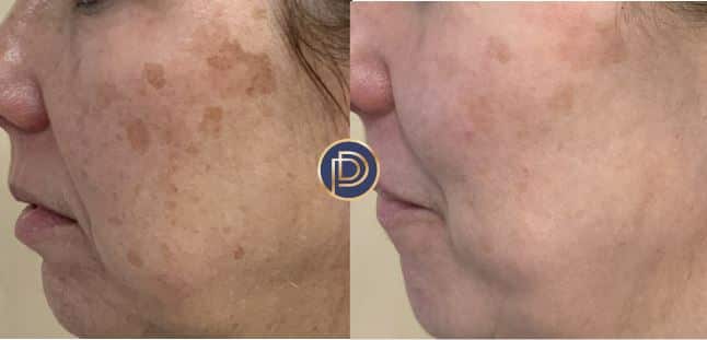 IPL Before and After Gallery by Dr. Burnett in Wellesley Massachusetts