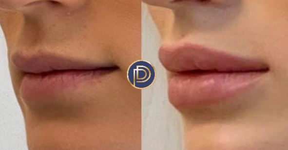 Lip Filler Before and After Gallery by Dr. Burnett in Wellesley Massachusetts