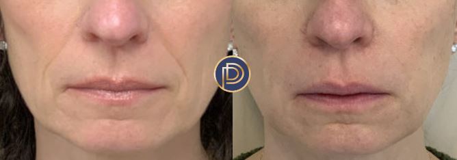 NLF Filler Before and After Gallery by Dr. Burnett in Wellesley Massachusetts