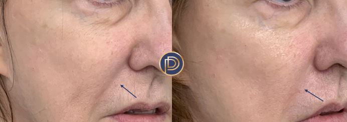 NLF Filler Before and After Gallery by Dr. Burnett in Wellesley Massachusetts