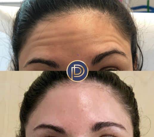 Neuromodulators (Botox) Before and After Gallery by Dr. Burnett in Wellesley Massachusetts