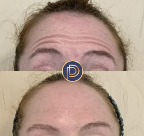 Neuromodulators (Botox) Before and After Gallery by Dr. Burnett in Wellesley Massachusetts