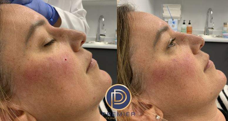 Nose Filler Before and After Gallery by Dr. Burnett in Wellesley Massachusetts